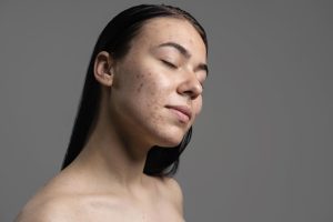 portrait-beautiful-young-woman-with-acne