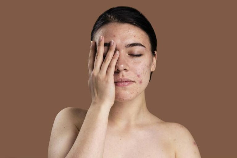 portrait-young-woman-being-confident-with-her-acne (1)