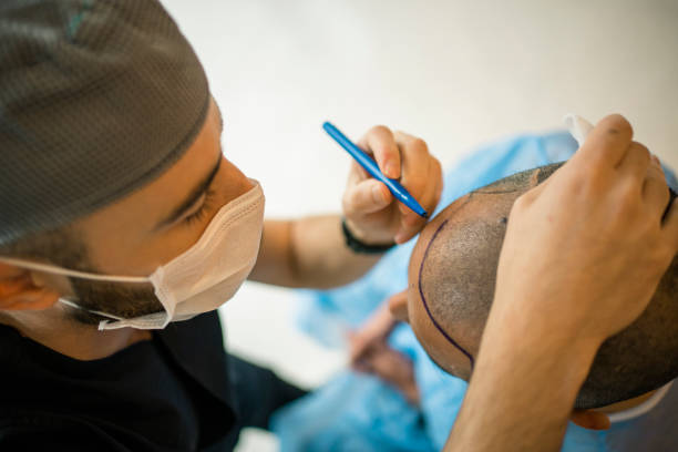 Hair transplant  Newest Indonesia