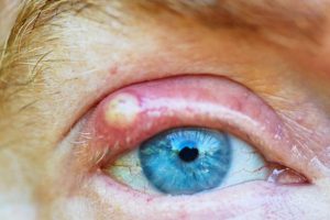 Blue-eyed mature man with an infected upper eyelid