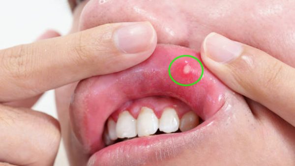 Ilustrasi Sariawan Di Bibir. Foto: iStock/Panuwat Dangsungnoen